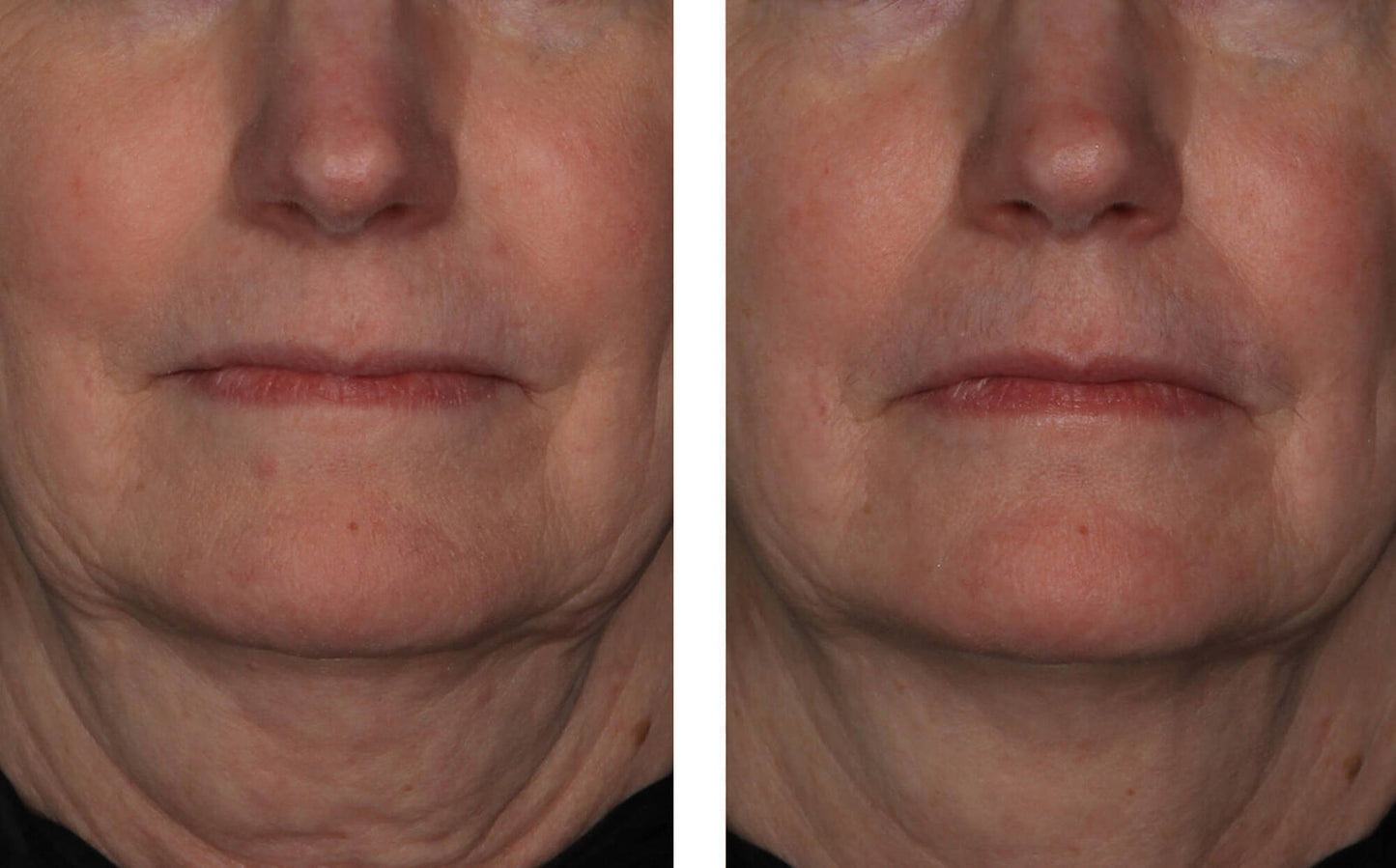 InterFuse Treatment Cream FACE & NECK 30 ml