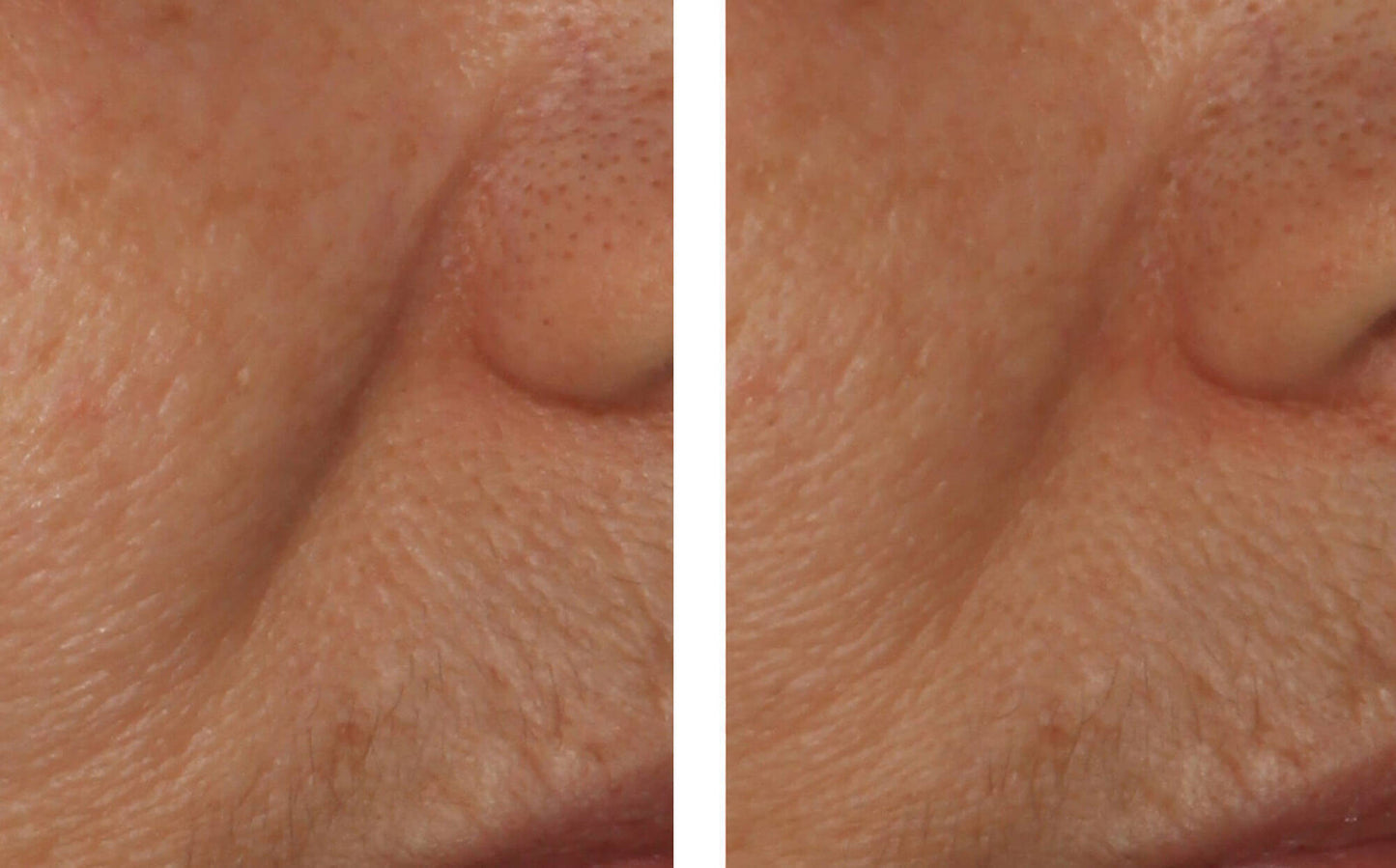 InterFuse Intensive Treatment LINES 15 ml